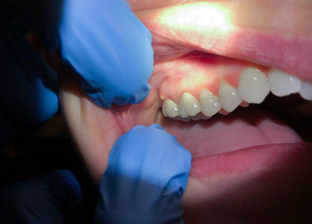 Best Urgent Care for Lost Fillings or Crowns in San Rafael, CA