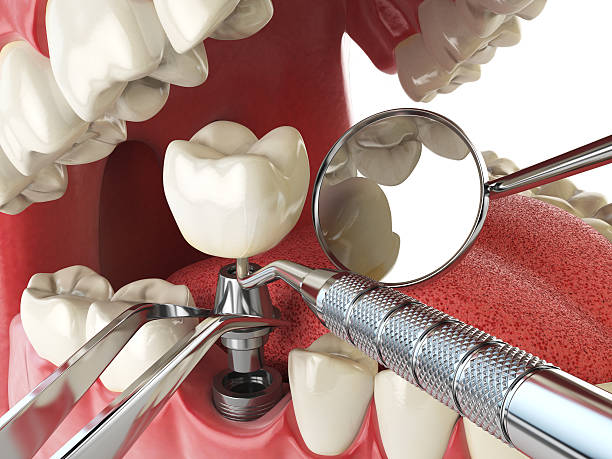 Best Emergency Treatment for Dental Infections or Abscesses in San Rafael, CA